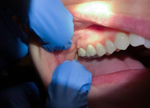 Best Emergency Dental Extractions in Moody Af, GA